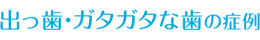 ガタガタな歯の症例